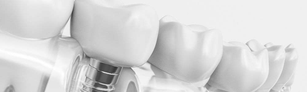 Zahnimplantate Starnberg - Implantologie