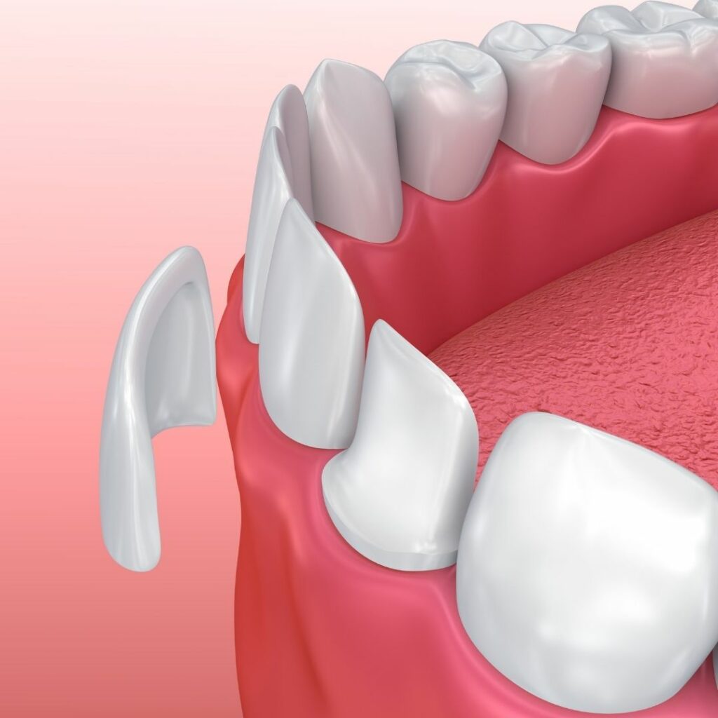 Keramische Verblendschalen für perfekte Zähne - Zahnarztpraxis in Starnberg