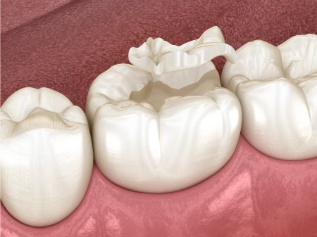 Schaubild zur Füllung bei Schaden am Zahn